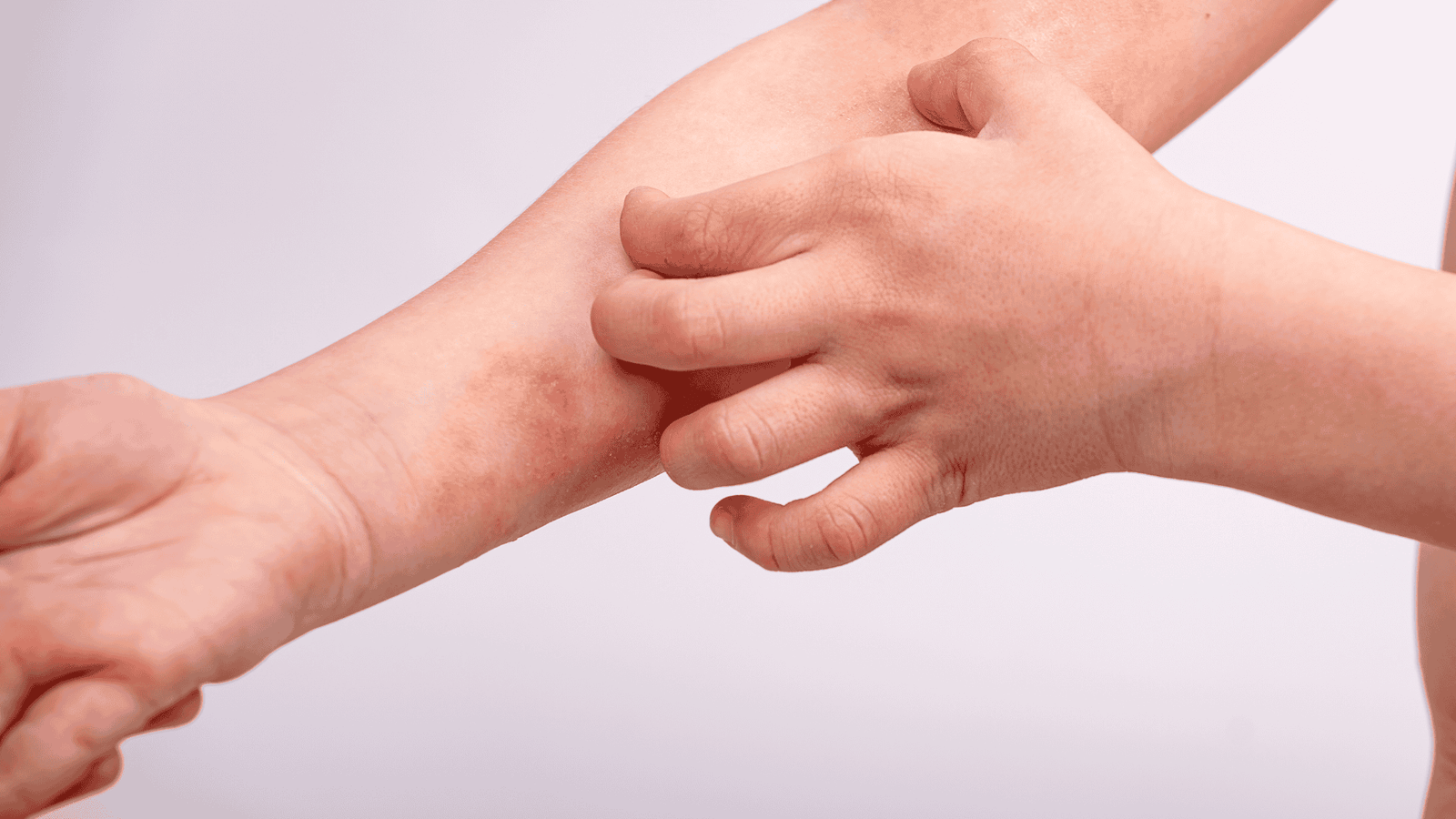 Dermatite Atópica | Nutrologia e Estética | Dra. Leires Ferreira