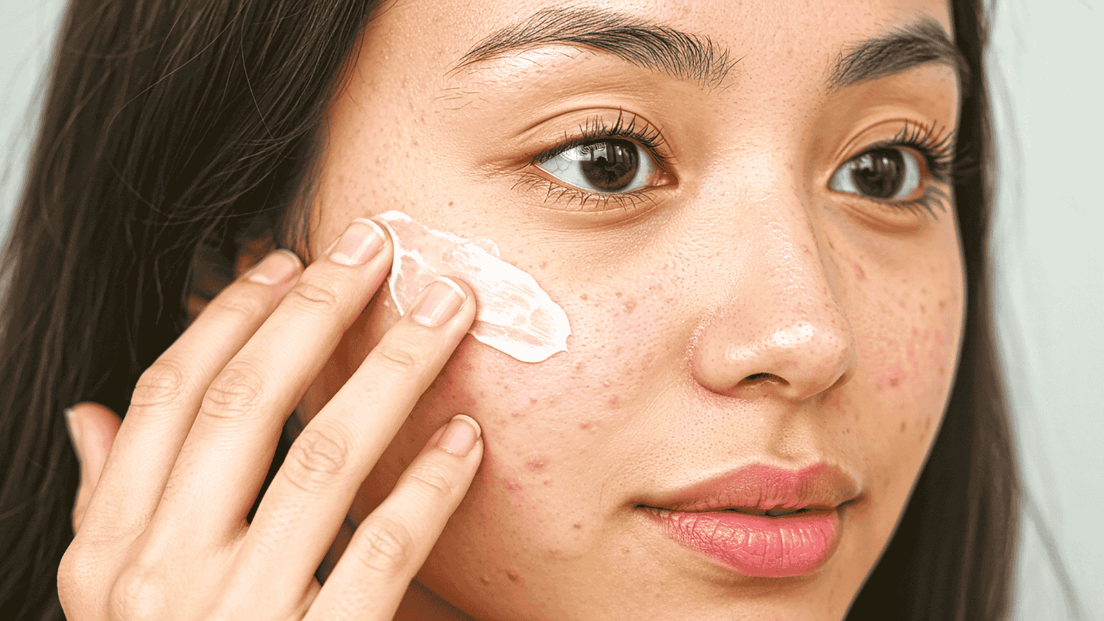 Acne da Mulher Adulta | Nutrologia e Estética | Dra. Leires Ferreira