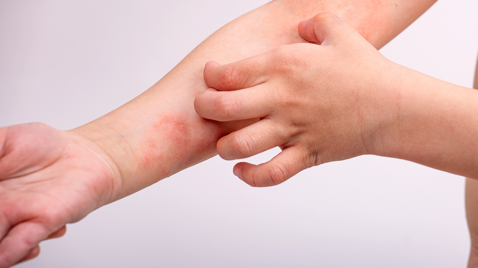 Dermatite de contato | Dra. Leires Ferreira