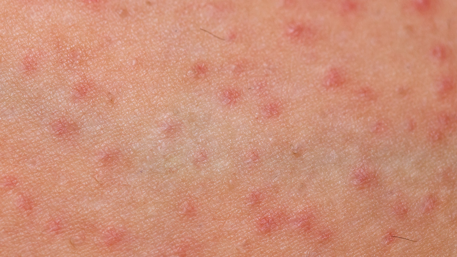 Foliculite | Dra. Leires Ferreira